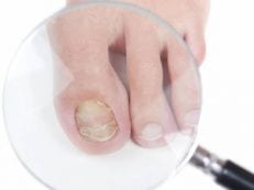 Онихогрифоз ногтей — признаки и проявления, лечение медикаментами и народными средствами, операция