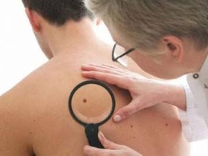 Опухоли кожи - признаки доброкачественных и злокачественных