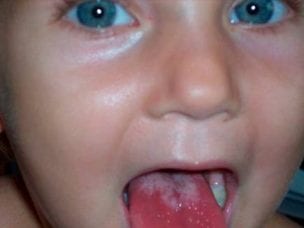 Осложнения после скарлатины у детей - причины, признаки и виды у мальчиков или девочек