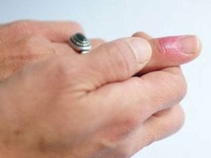 Паронихий пальца - причины возникновения заболевания, симптомы, диагностика и методы лечения