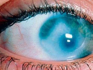Причины дистрофии сетчатки глаза - врожденные и возрастные