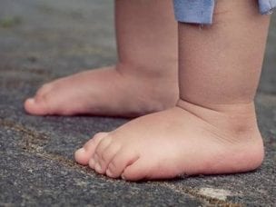 Причины вальгусного плоскостопия у детей - внутренние и внешние