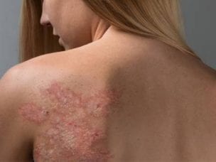 Признаки псориаза у женщин: первые проявления на коже