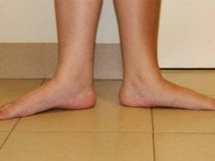 Профилактика плоскостопия у взрослых - упражнения и выбор обуви