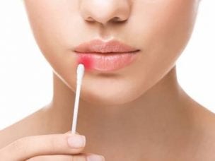 Простуда на губах – чем лечить для быстрого избавления от заболевания