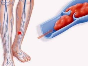 Симптомы тромбоза вен и артерий