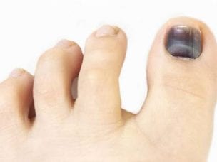 Синие ногти на руках или ногах - причины возникновения, лечение и профилактика, возможные осложнения