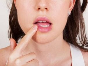 Трещины в уголках губ: причины и лечение заед