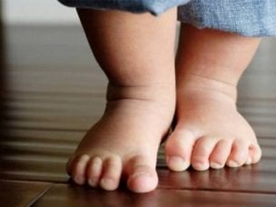 Упражнения при вальгусной деформации стопы у детей - как выполнять