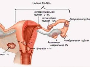 Виды внематочной беременности: как развивается патология