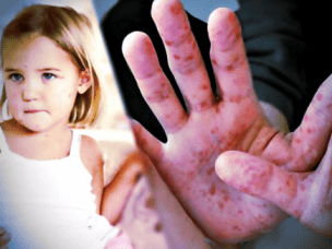 Вирус Коксаки у детей и взрослых -  симптомы и лечение