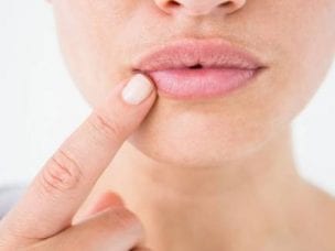 Заеды на губах - чем лечить у детей и взрослых