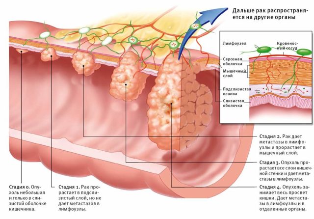Рак кишечника на схеме