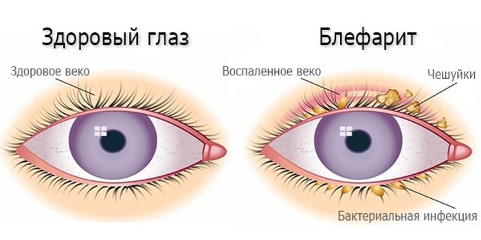 Здоровый глаз и блефарит