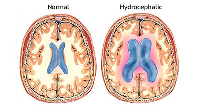 Мозг при гидроцефалии