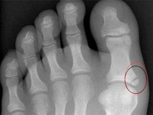 Признаки перелома большого пальца на ноге