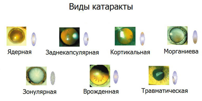 Разновидности катаракты