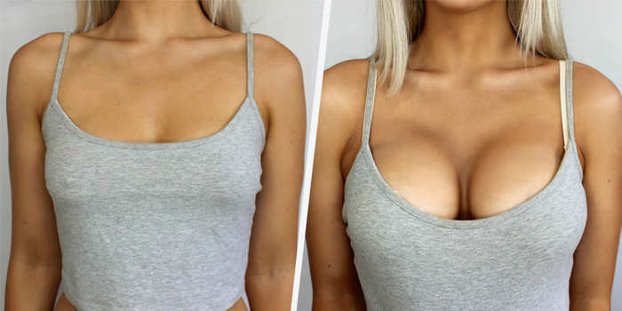 Фото до и после увеличения груди