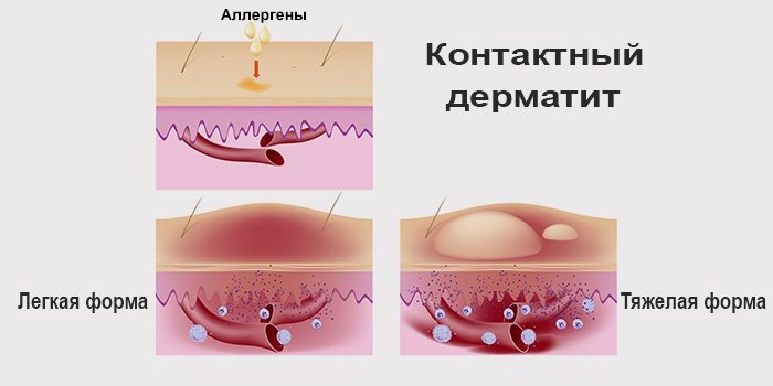 Формы контактного дерматита